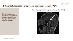Differential diagnosis – progressive supranuclear palsy (PSP)